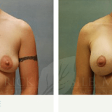 Breast Lift with Augmentation Patient 1