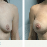 Breast Augmentation Patient 4