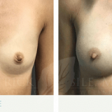 Breast Augmentation 3004