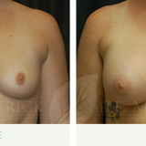 Breast Augmentation 3000