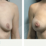 Breast Augmentation 3001