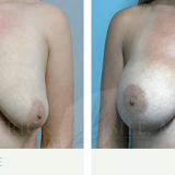 Breast Augmentation 3002