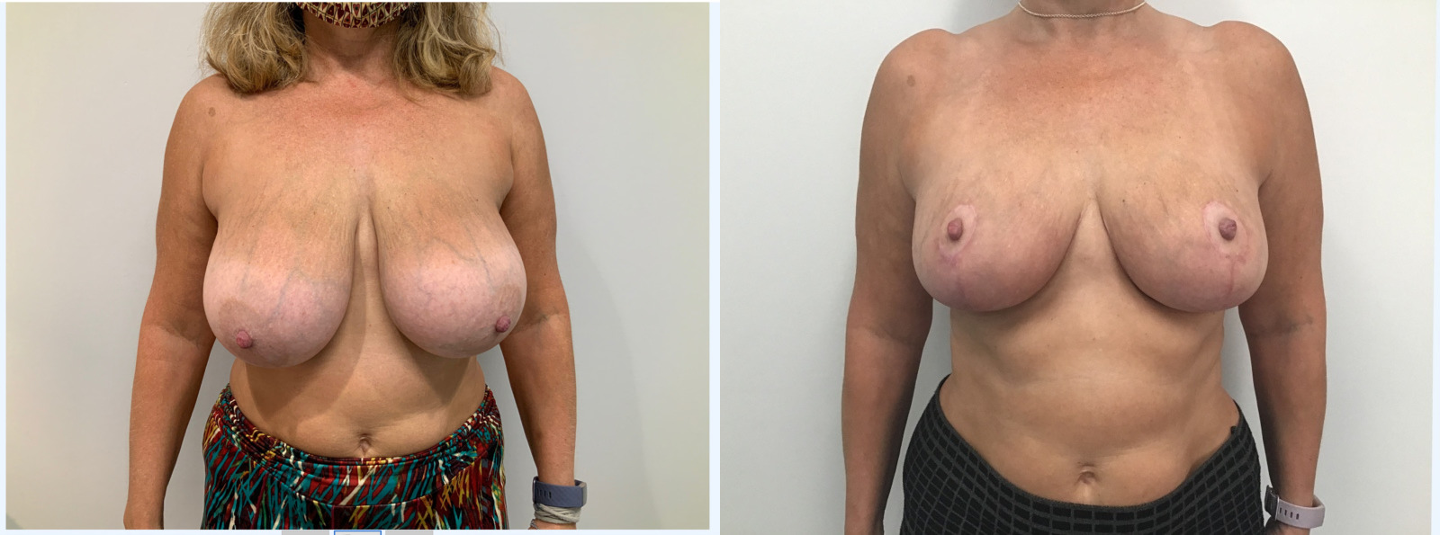 Breast Reduction 5000